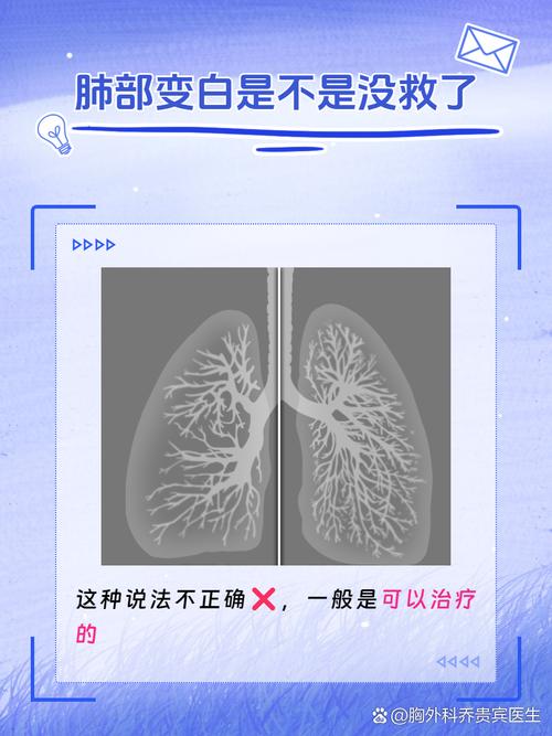 男子自行服药延误治疗，咳嗽多日致白肺进ICU的悲剧，警惕健康风险，及时就医为上策  第2张