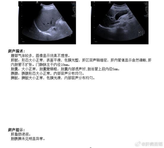 揭秘脂肪肝，从成因到防治的全面解析  第4张