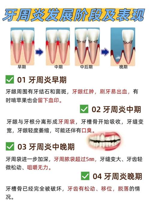 牙周病与脑卒中风险，密切关联的警示标题  第2张