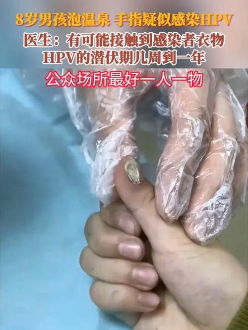 警惕HPV感染风险，8岁童泡温泉后手指异常情况需引起重视  第3张