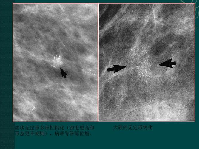 体检报告中的钙化含义详解  第3张